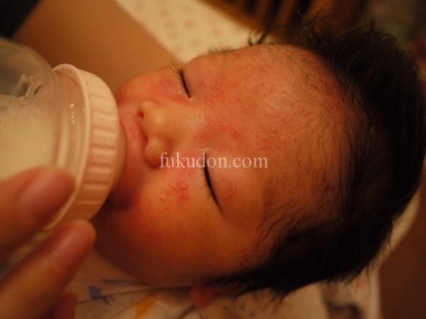 生後1ヶ月頃の乳児湿疹は小児科・皮膚科どっちに行くべき？ ふくどん